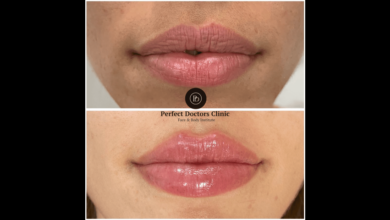 Juvederm Fillers