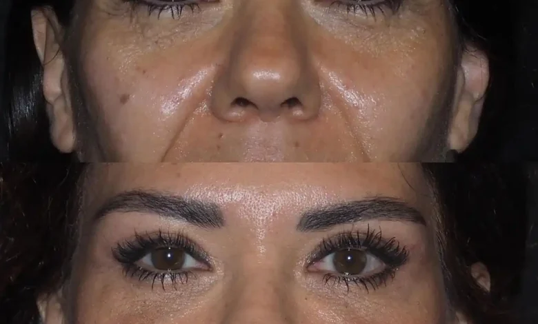 Eye Bag Removal