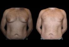 Before and after male breast reduction result