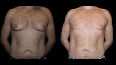 Before and after male breast reduction result