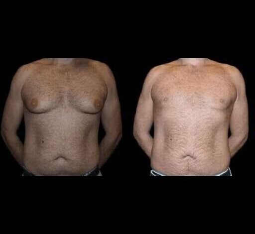 Before and after male breast reduction result